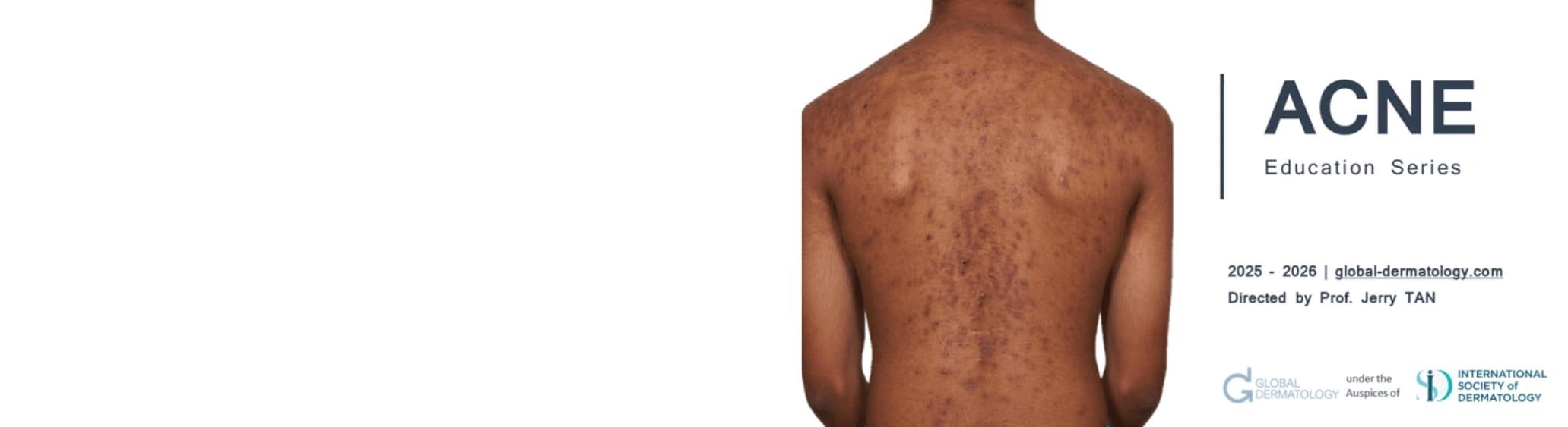 Acne education hero