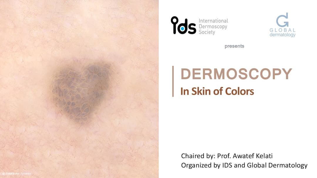 Dermoscopy Skin of Color