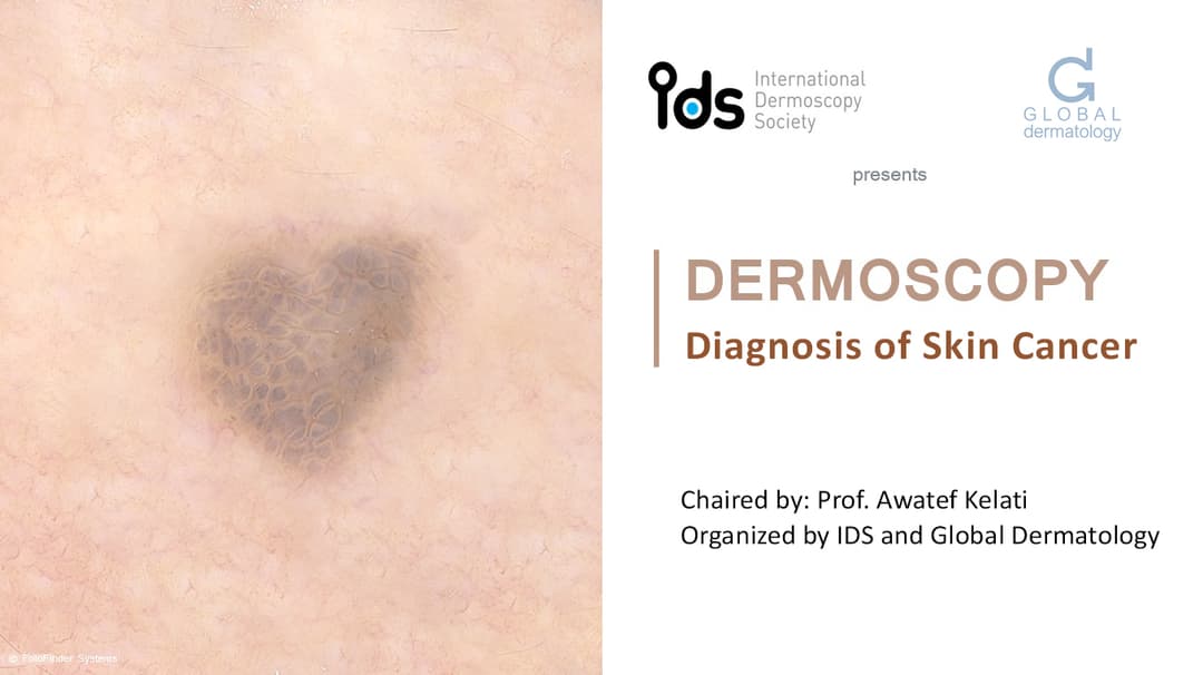 Dermoscopy | Diagnosis of Skin Cancer
