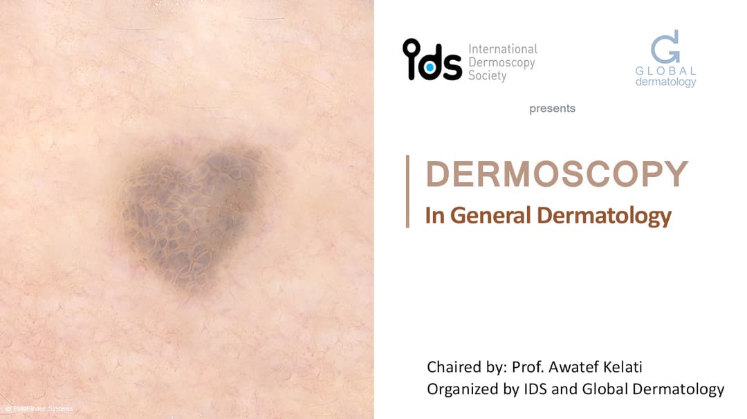 Dermoscopy in General Dermatology