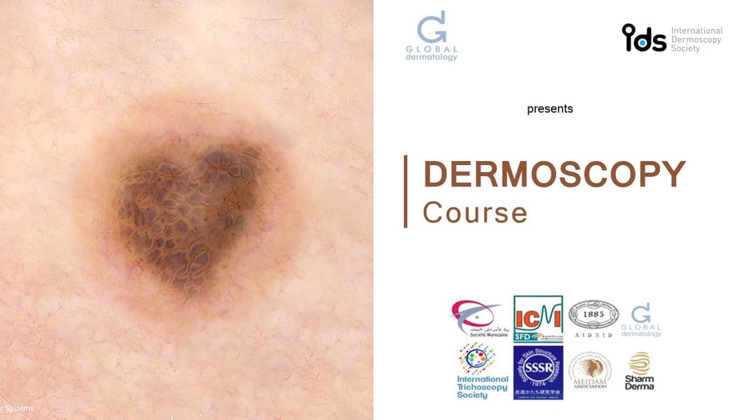 Dermoscopy