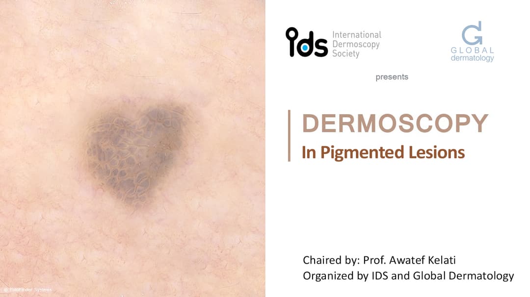 Dermoscopy in Pigmented lesions